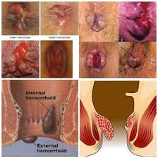 Image Herbal Wasir Tanpa Operasi