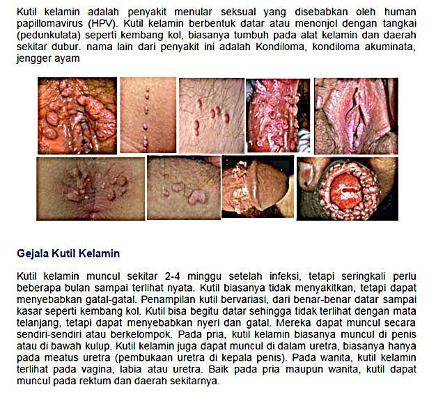 Obat Kutil Kelamin Di Morowali,Obat Kutil Kemaluan Di Pekalongan,Cara Mengobati Kutil Kelamin Di Kota Binjai,Cara Mengatasi Kutil Kelamin Di Kalimantan Barat,Pengobatan Kutil Kelamin Di Aceh,Cara Menghilangkan Kutil Kelamin Di Maybrat,Pengobatan Kutil Kemaluan Di Muna,Obat Kutil Kelamin Tanpa Operasi Di Pariaman,Obat Kutil Kelamin Herbal Di Bantaeng,Obat Kutil Kelamin Di Apotik Di Kota Gorontalo,Obat Kutil Kemaluan Di Banyumas,Pengobatan Kutil Kemaluan Di Palembang,Obat Kutil Di Sekitar Kelamin,Obat Kutil Di Sekitar Kemaluan,Obat Kutil Di Sekitar Penis,Obat Kutil Di Sekitar Vagina,Cara Mengobati Kutil Di Sekitar Kelamin,Cara Mengatasi Kutil Di Sekitar Kelamin,Cara Menghilangkan Kutil Di Sekitar Kelamin